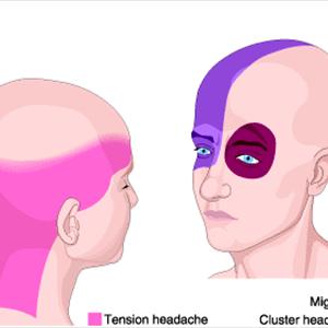 Migraine Headaces - Migraine Remedies, How To Treat Migraine