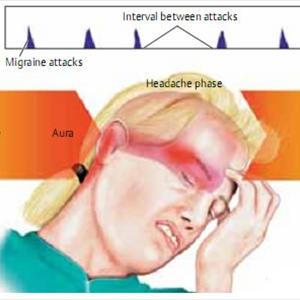 Hypertension Headache - Migraine Food Triggers
