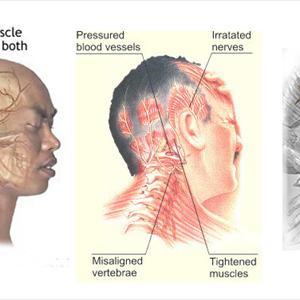  Migraines And Rebound Headaches