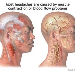 Natural Headache Relievers - Migraine Headaches Or Tension Headaches - Which Do You Have?