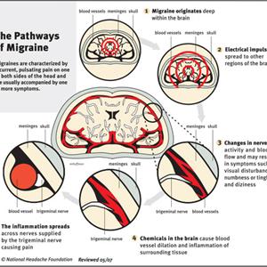 Complicated Migraine Headache 